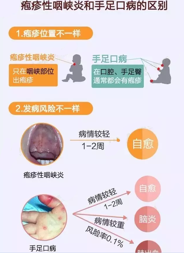 幼儿园比手足口病还厉害的疱疹性咽峡炎