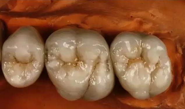 别错过孩子牙齿窝沟封闭的最佳年龄